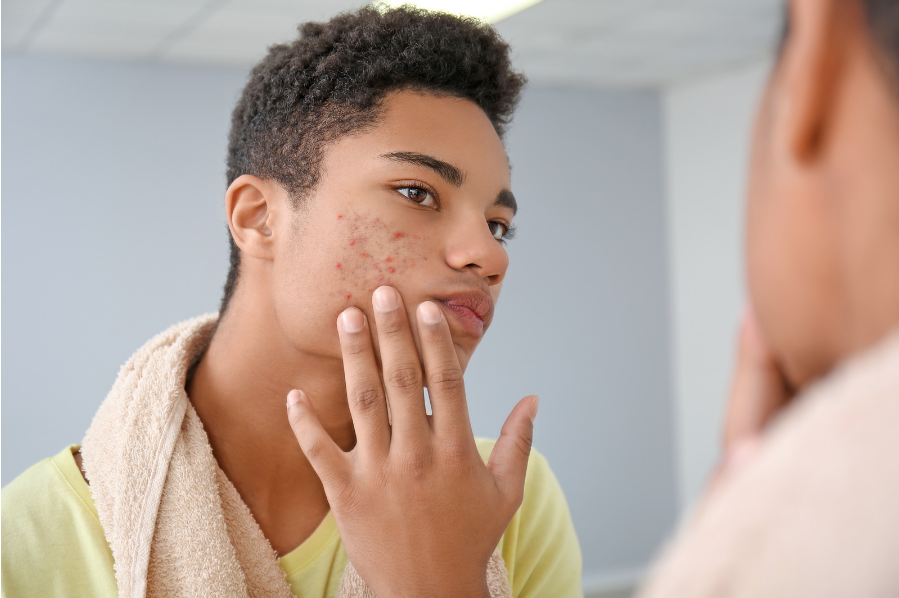 AcnÃ© hormonale, rosacÃ©e : de quoi s'agit-il ?